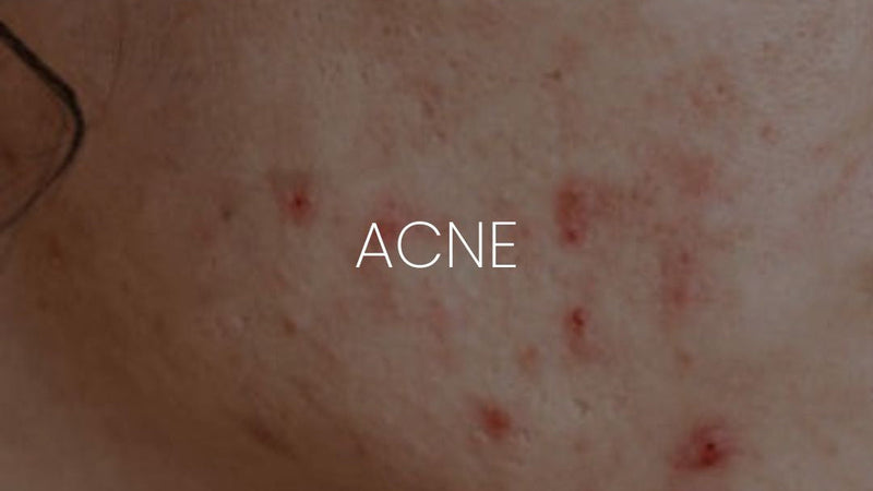 IMPERFECCIONES - Onix Skincare