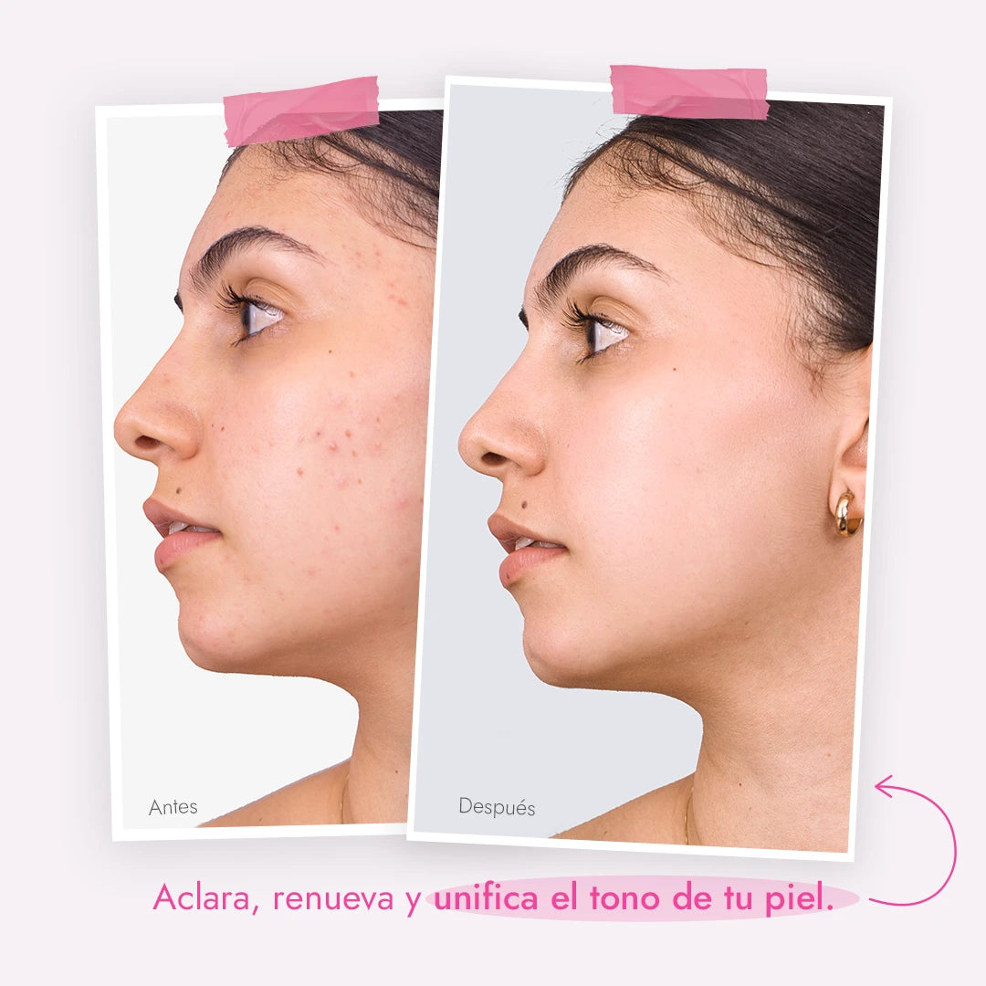 Comparación antes y después del uso del tónico Onix Skincare, mostrando una mejora significativa en la piel: de imperfecciones a un tono más claro y unificado.